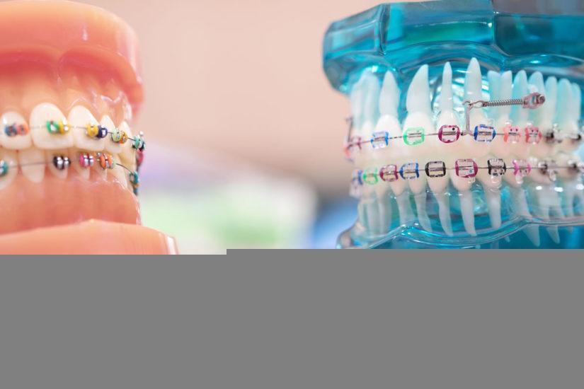درمان ارتودنسی چگونه به نظم دندان ها کمک می کند؟